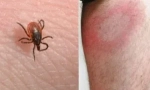 Kako se prenosi borrelioza (lyme bolest)?
